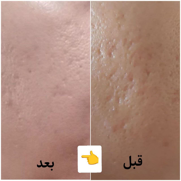 کرم تضمینی منافذ باز (جای جوش و صورت پرتقالی)